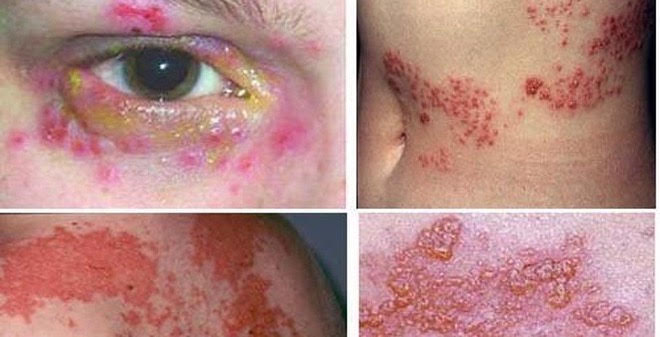 Bệnh giang mai 2 GM